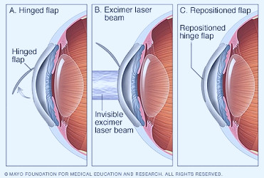 LASIK eye surgery - Mayo Clinic